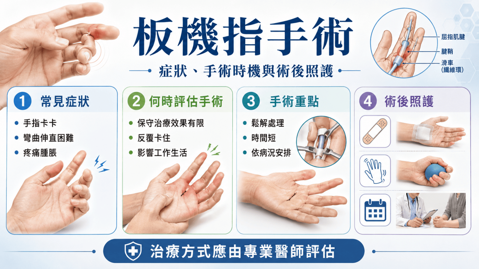 板機指是常見的手部問題之一,典型症狀包含手指卡住